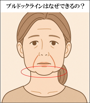 ブルドックラインはなぜできるのかイラスト