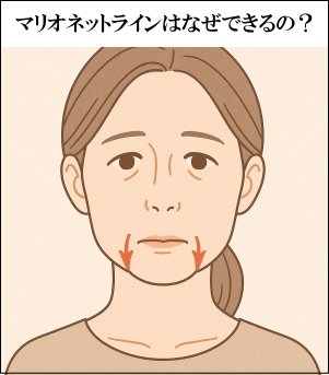 マリオネットラインはなぜできるのか？イラスト