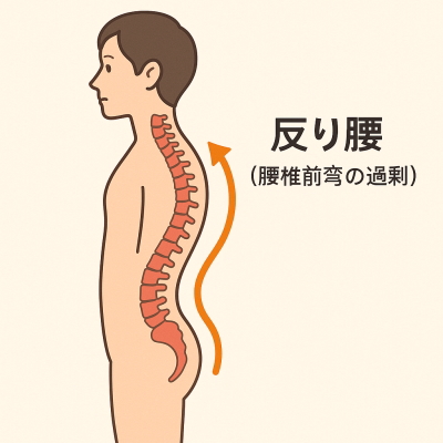 反り腰のイラスト