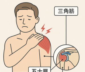 三角筋と五十肩の痛みの関係イラスト